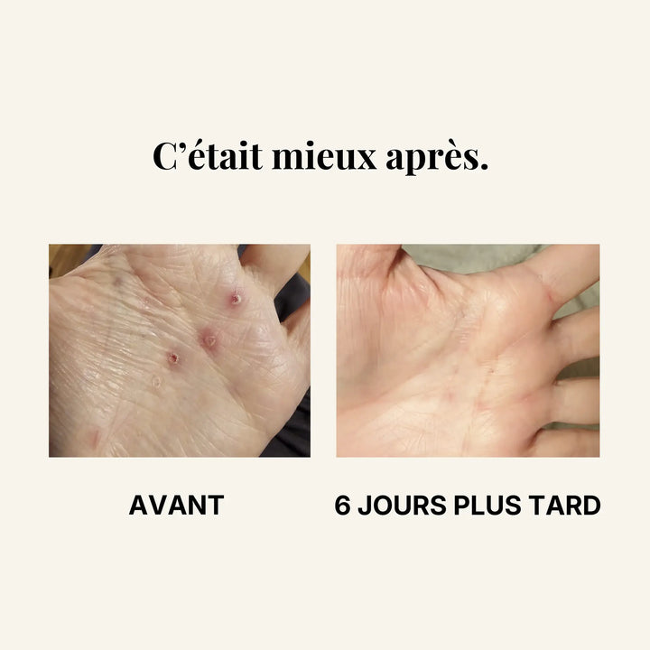 Résultats avant-après au niveau des mains suite à la prise de zinecol. 